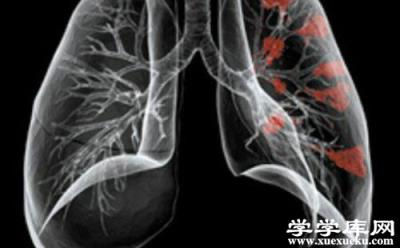 支氣管肺炎的癥狀 支氣管肺炎如何鑒別