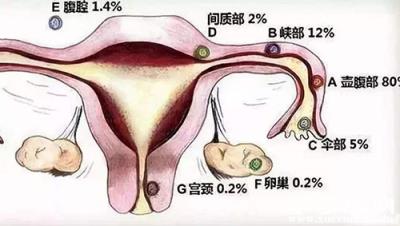 宮外孕會來月經嗎 宮外孕怎么辦